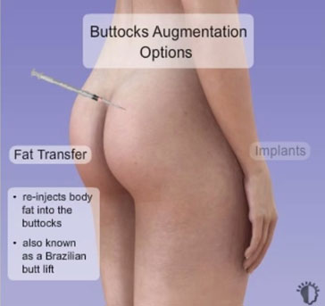 Buttock-augmentation-lipofilling-Tunisia